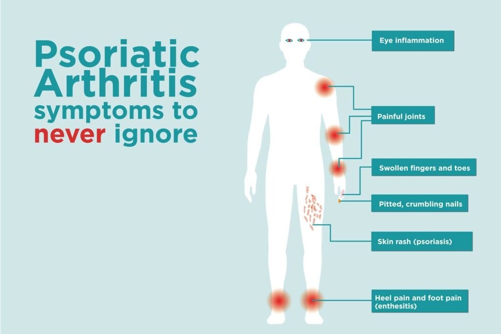 Psoriasis Treatment Medical And Natural Watertown CT